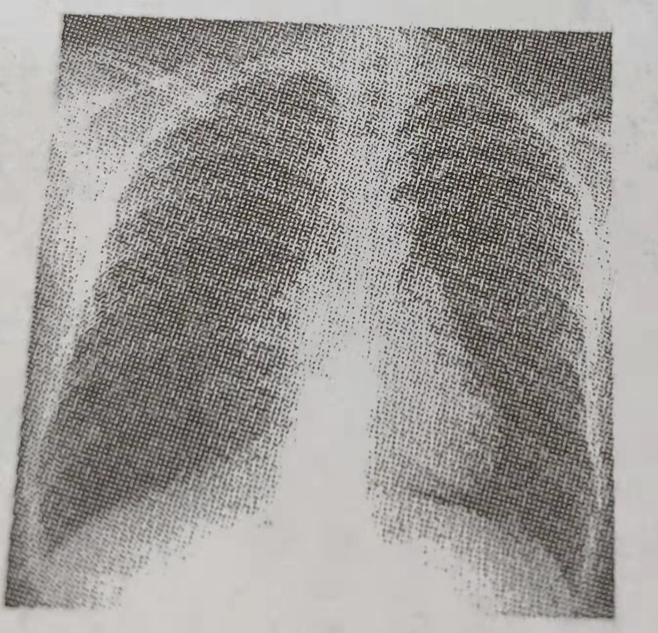 2017年安徽成人高考专升本《医学综合》真题及答案解析—男性，26岁。举重物时突发胸痛，进行性呼吸困难急诊就诊。既往体健。胸片如图，右肺中外带无肺纹理。对上述患者应采取的最佳措施是(图1)